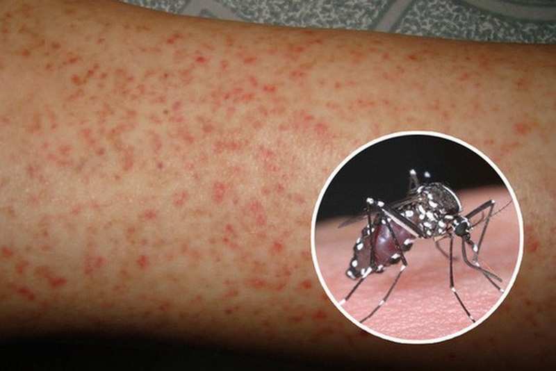 Lào cảnh báo người dân về sự nguy hiểm của dịch sốt xuất huyết