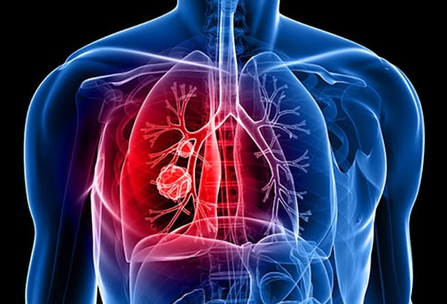 Triệu chứng của bệnh ung thư phổi mà bạn không hề ngờ tới