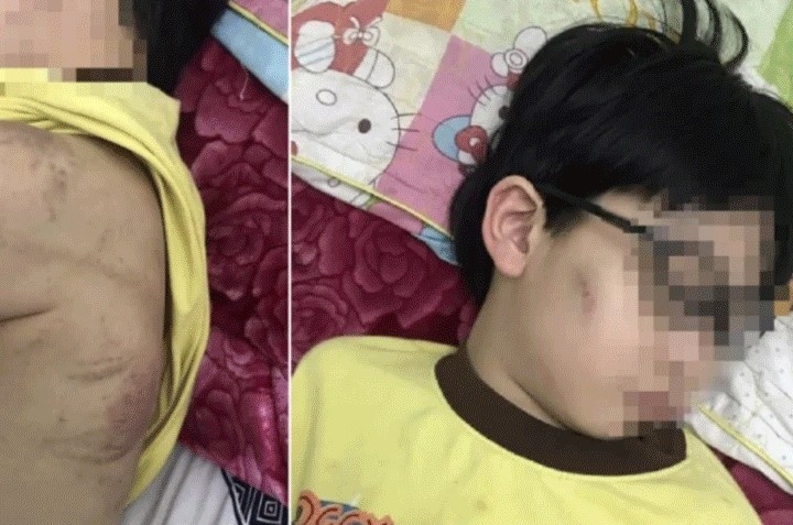 Chính quyền bác thông tin bé trai bị mẹ bạo hành phải nhập viện ở Quảng Ninh
