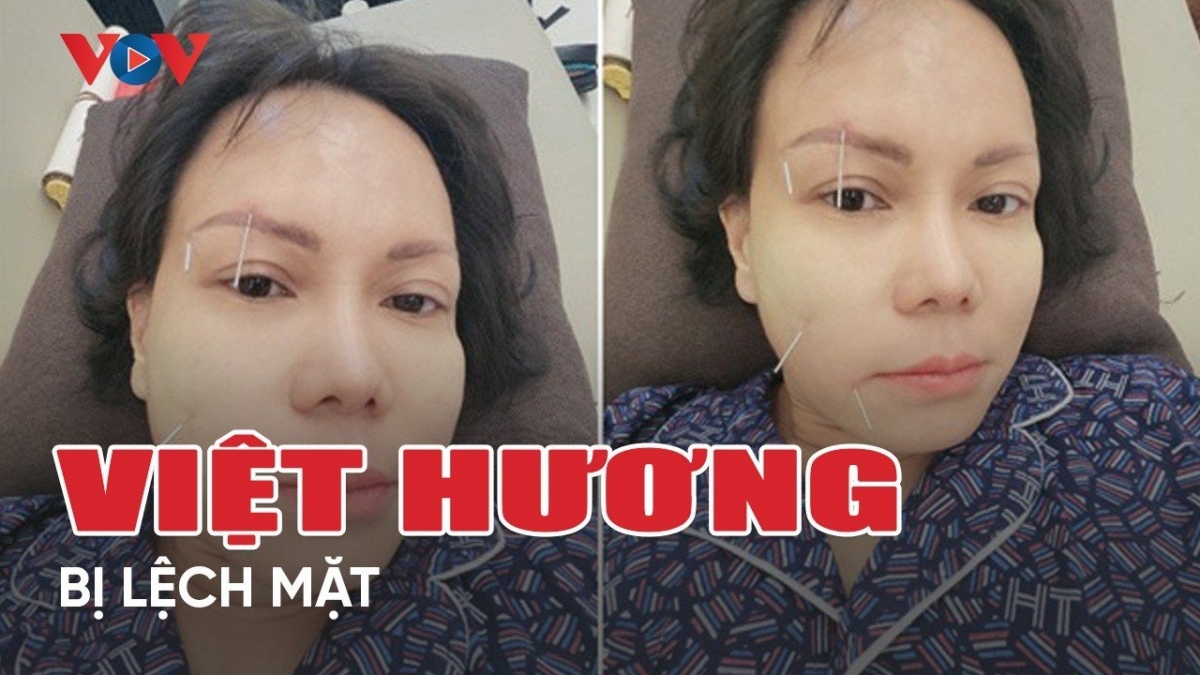 Chuyện showbiz 6/4: Việt Hương bị lệch mặt, phải điều trị châm cứu