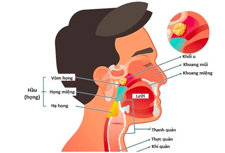 Căn bệnh ung thư đàn ông 30-50 tuổi ở Việt Nam thường gặp