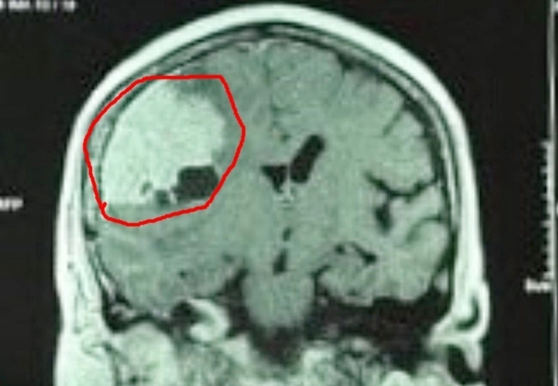 Phẫu thuật cắt trọn khối u màng não khổng lồ cho bệnh nhân 68 tuổi