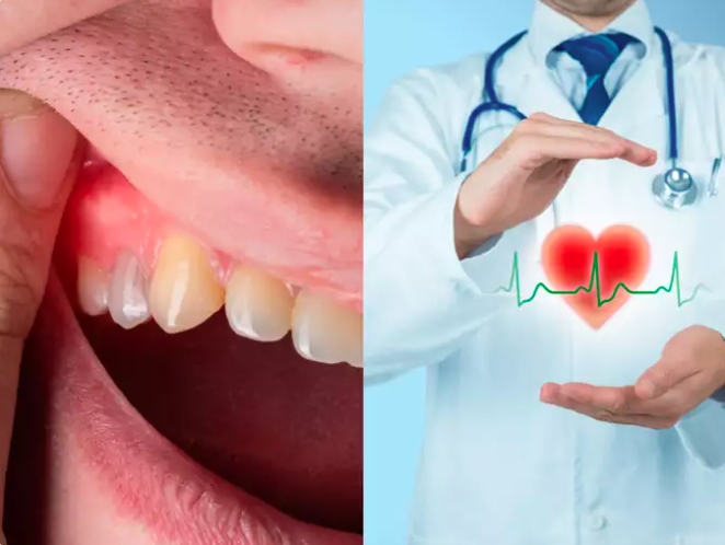 Bệnh nướu răng không được điều trị làm tăng nguy cơ mắc bệnh tim