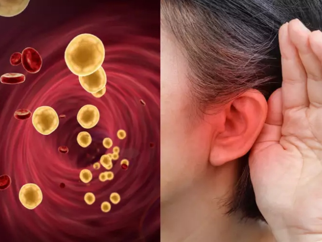 Dấu hiệu ít ai biết về cholesterol cao thông qua đôi tai
