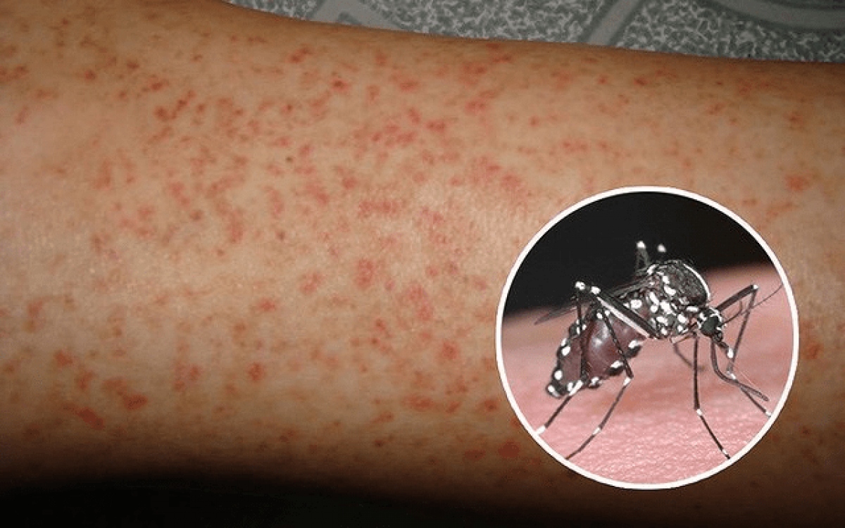 Vì sao sốt xuất huyết tái nhiễm lại nặng hơn lần đầu?