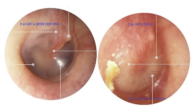 1. Nguyên Nhân Gây Viêm Tai Giữa Ở Trẻ 1 Tuổi