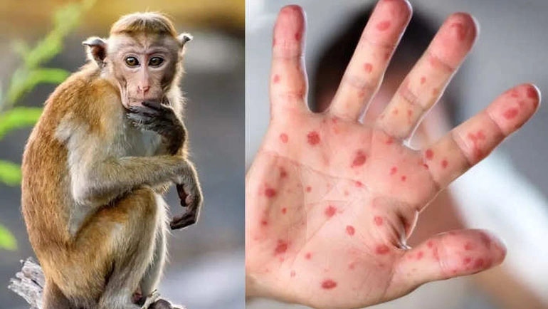 Một người ở Cà Mau dương tính bệnh đậu mùa khỉ