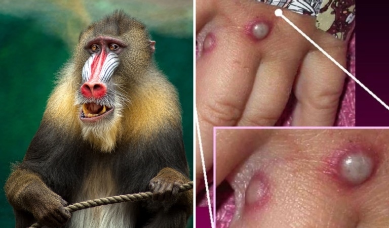 Kiên Giang ghi nhận 3 trường hợp mắc bệnh đậu mùa khỉ