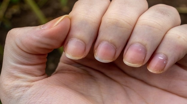 Dấu hiệu ít được chú ý trên móng tay có thể cảnh báo bạn về bệnh ung thư