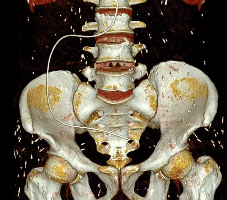 Chụp CT, tá hỏa phát hiện sán rải rác khắp cơ thể người bệnh