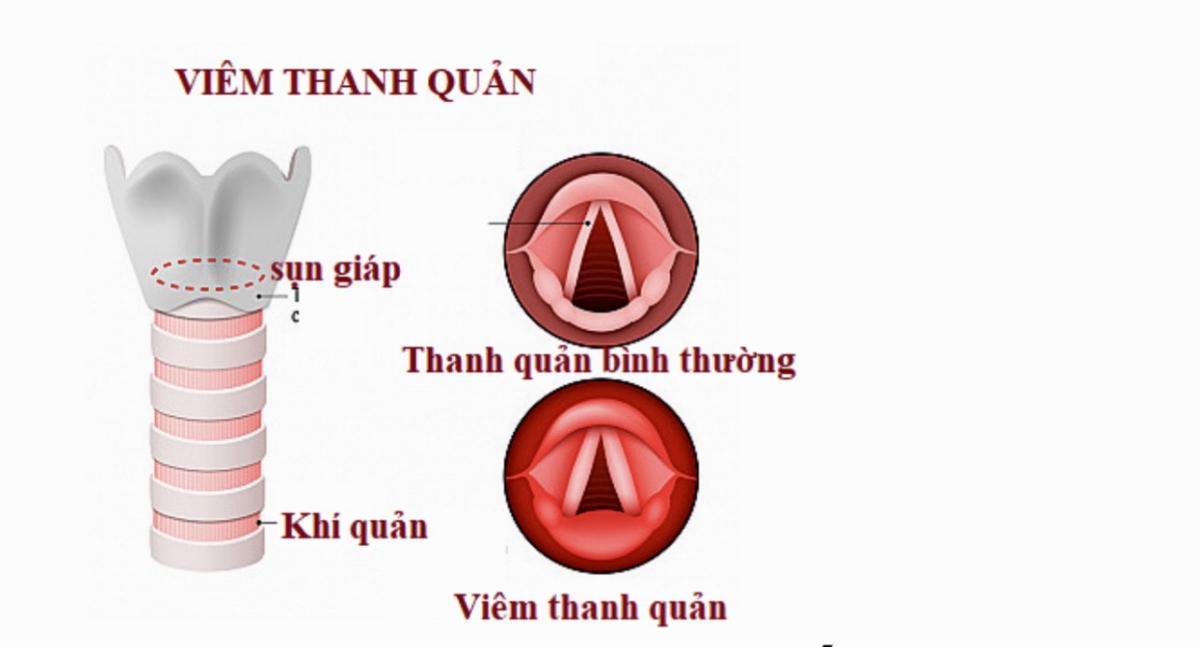 Bác sĩ tư vấn cách chữa trị bệnh khàn tiếng, khàn giọng