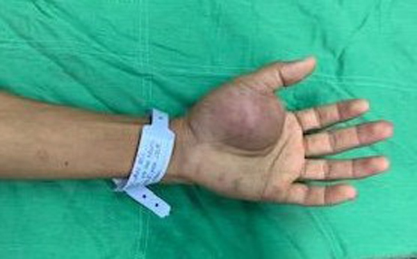 Phẫu thuật thành công cho bệnh nhân bị bướu máu vùng bàn tay