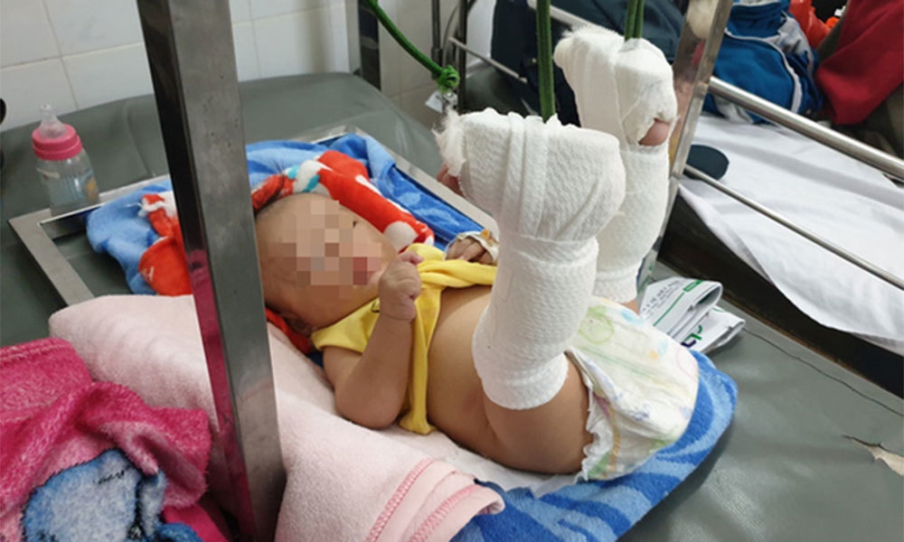 Bé trai 4 tháng tuổi bị cha đánh gãy chân vì không chịu ngủ