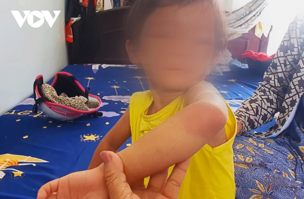 Bảo vệ khẩn cấp bé 4 tuổi bị đánh sưng phù mặt ở Cà Mau