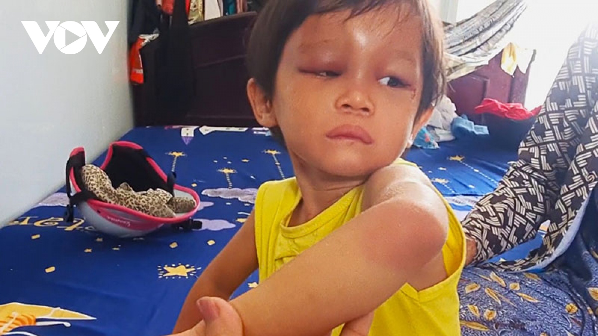 Cháu bé 4 tuổi tại Cà Mau được giải cứu với khuôn mặt bị sưng húp